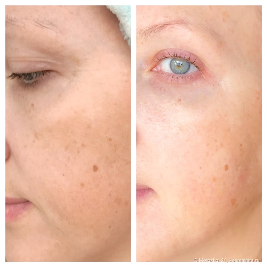 Ретинол srx serjudicare synergy - moй pervый serheзnыйretinol ...