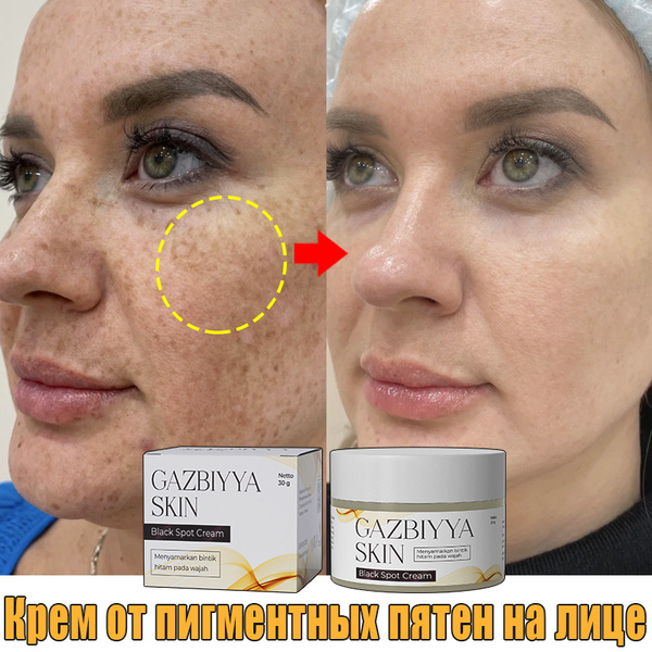 Gazbiyya skin krem ​​-krem -yplebelivanip yudalenip