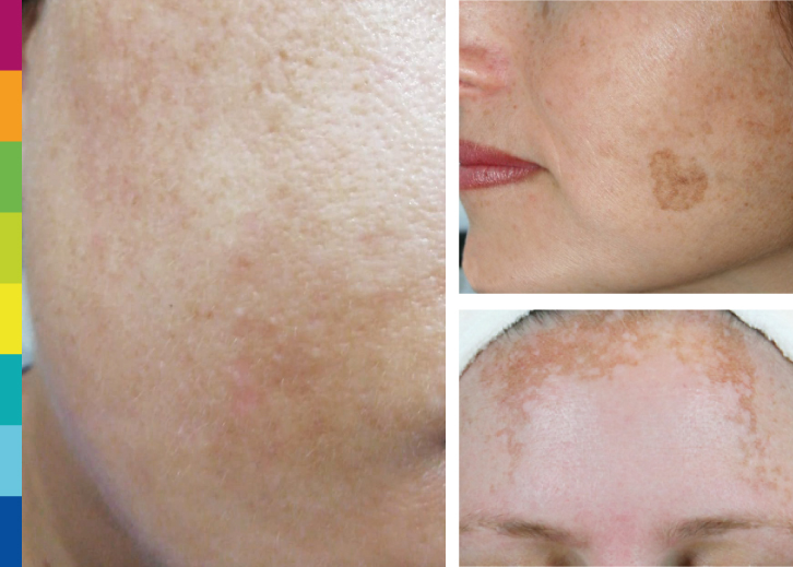 Dermaquest »kakoй kremempomohet otpeigentnыхpaonten | 